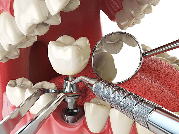 Best Emergency Dental Extractions in Adelanto, CA